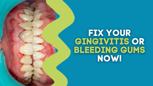 FIX YOUR GINGIVITIS OR BLEEDING GUMS NOW!