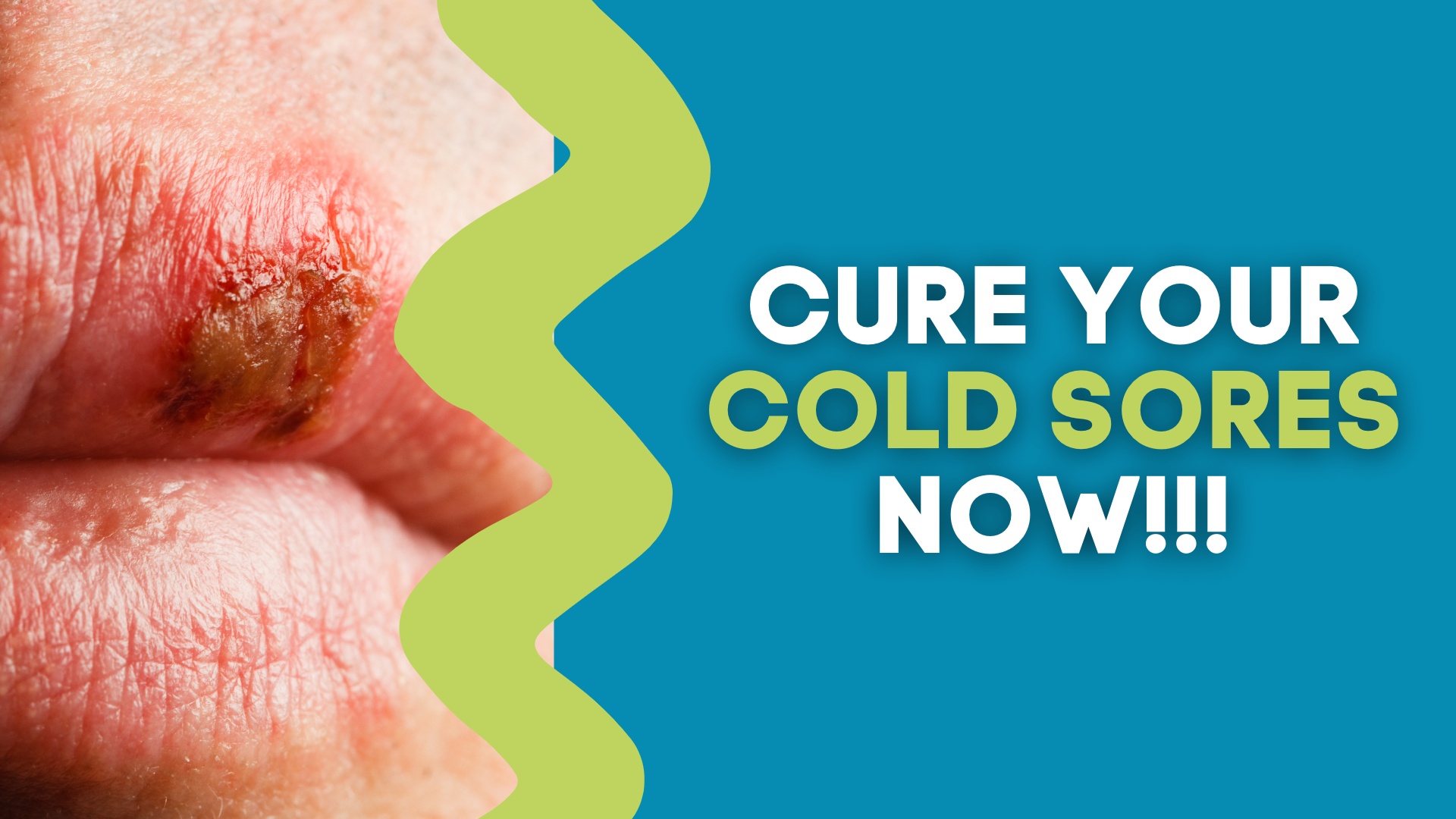 cure-your-cold-sores-now-the-gut-health-hub