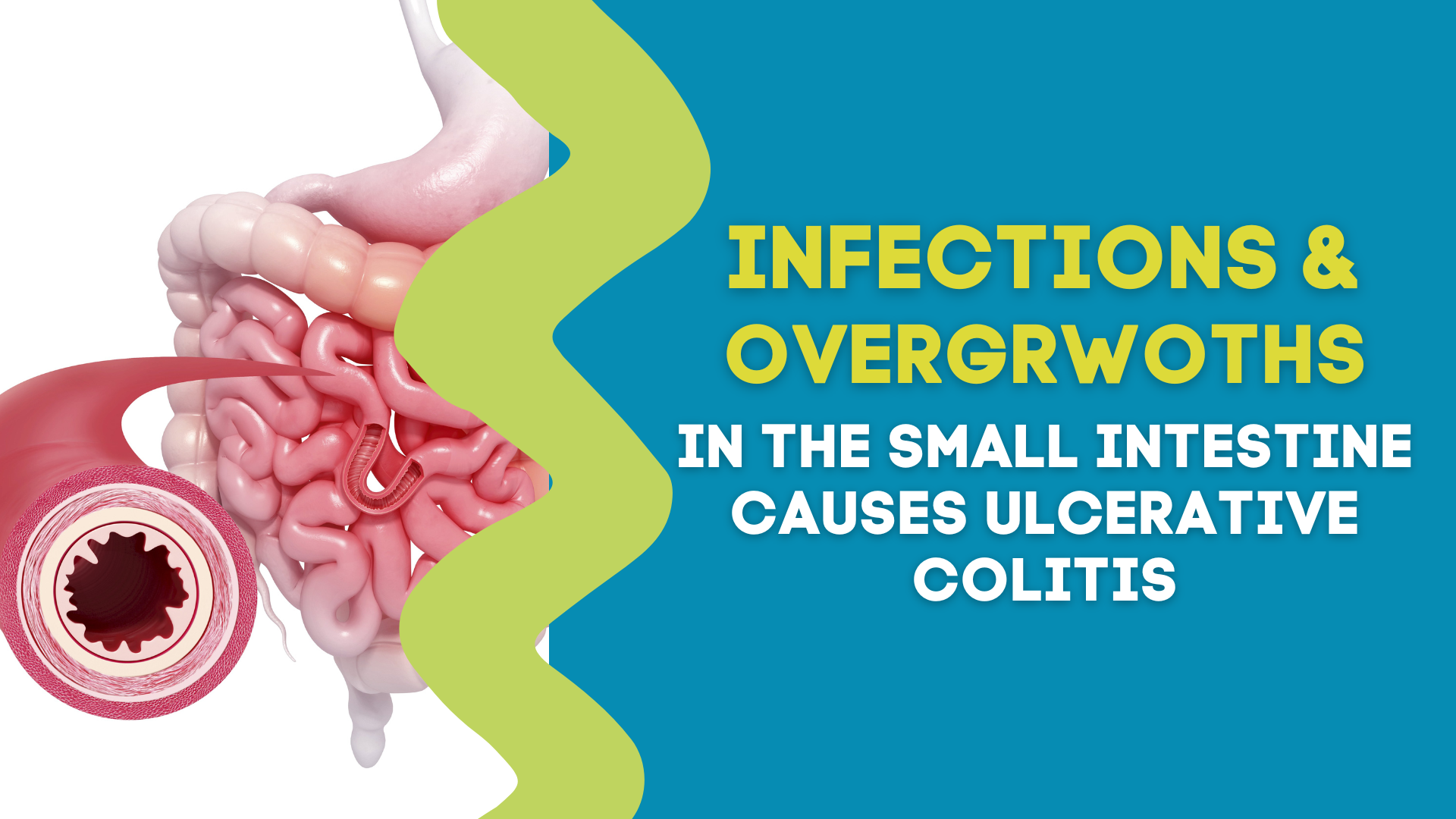 INFECTIONS AND OVERGROWTHS IN SMALL INTESTINES CAUSE ULCERATIVE COLITI ...