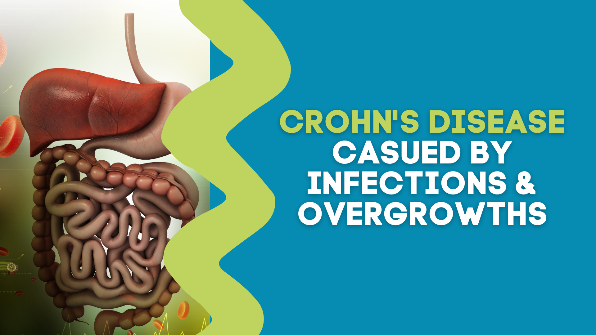 Crohn’s Disease Created by Infections & Overgrowths | The Gut Health Hub